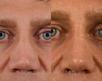 Man treated with Revision Rhinoplasty