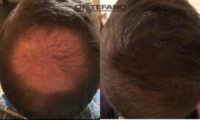 45 year old man treated with the IGT Hair Transplant