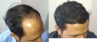 35-44 year old man treated with FUE Hair Transplant
