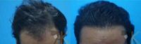 24 year old man treated with Hair Transplant