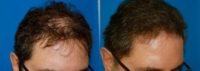 Hair Restoration Surgery | Hair Transplant