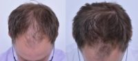 25-34 year old Male Treated His Hair Loss with Low-level Laser Therapy - 9 month Results