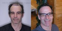 Norwood 6 Patient 5000 Grafts Hair Transplant Before & After