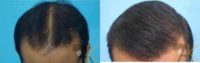 36 year old man treated with Hair Transplant