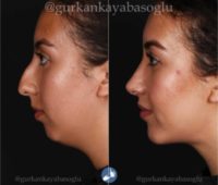 18-24 year old woman treated with Rhinoplasty, Chin Implant, Chin Liposuction