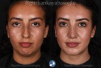 18-24 year old woman treated with Rhinoplasty, Chin Implant, Chin Liposuction