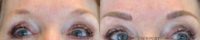 35-44 year old woman treated with Microblading