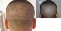 25-34 year old man with FUT (strip) scar treated with FUE Hair Transplant