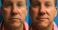 50 year old male with Facial Deficits was treated with Fillers