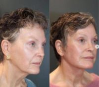 70 year old woman treated with Neck Lift