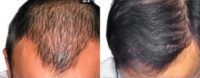 Man treated with Hair Transplant, PRP for Hair Loss