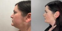 25-34 year old woman treated with Rhinoplasty, Genioplasty, Buccal Fat Removal, Chin Liposuction, Neck Lift