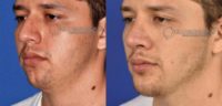 18-24 year old man treated with Nose Surgery