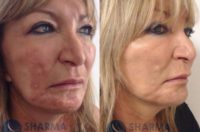 45-54 year old woman treated with Scar Removal