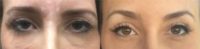 25-34 year old woman treated with Botox to lift the brows