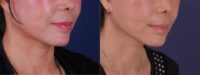 Revisional face and neck lift