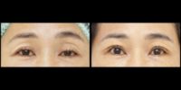 55-64 year old woman treated with Ptosis Surgery, Eyelid Surgery