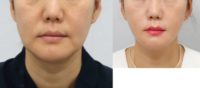 45-54 year old woman treated with Facelift, SMAS Facelift, Liposuction