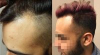 25-34 y.o. man treated with FUE Hair Transplant by Dr. Christopher Varona in Orange County, CA
