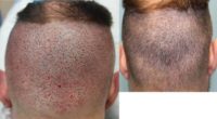 Donor Site Healing at 1 week after 1100 Graft FUE Hair Transplant