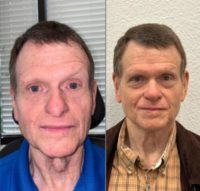 69 year old male who underwent septorhinoplasty