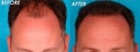 Man treated with Hair Transplant