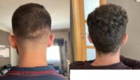 18-24 year old man treated with Hair Transplant, Hair Loss Treatment, Hair Loss, Hair Restoration, Smile Hair Clinic, FUE, FUE H