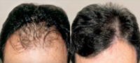 Male Hair Transplant: Before and After Photo