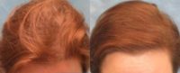 55-64 year old woman treated with FUE Hair Transplant