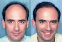 55-64 year old man treated with Hair Loss Treatment