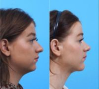 Woman treated with Chin Implant, FaceTite, Rhinoplasty