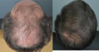 51 yr man, NW VI, treated with Hair Transplant - Combined Crisóstomo Technique (FUT+FUE) = 5,092 FUs