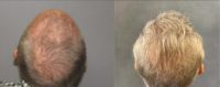 Man treated with Hair Transplant