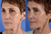55-64 year old woman treated with Facelift, Neck Lift, Deep Plane Facelift