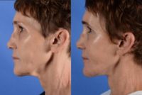 55-64 year old woman treated with Facelift, Neck Lift, Deep Plane Facelift