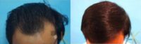 23 year old man treated with Hair Transplant
