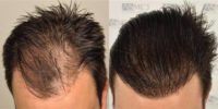25-34 year old man treated with FUE Hair Transplant (3408 Grafts)