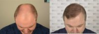 35-44 year old man treated with FUE Hair Transplant