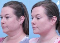 45-54 year old woman treated with Buccal Fat Removal, Neck Lift