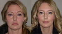 35-44 year old woman treated with Upper Lid Blepharoplasty