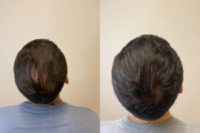 18-24 year old man treated with PRP for Hair Loss