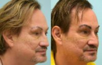 55-64 year old man treated with Eyebrow Transplant
