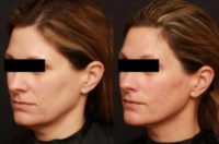 35-44 year old woman treated with Ultherapy