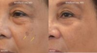 65-74 year old woman treated with PicoSure