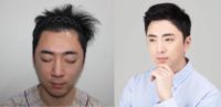 25-34 year old man treated with Hair Transplant, FUE Hair Transplant