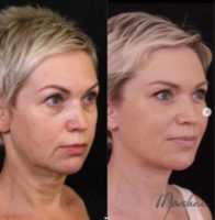 50 year old woman treated with Deep Plane Facelift