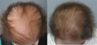 64 year old woman with advanced baldness treated with Hair Transplant (two sessions) = 4,614 FUs