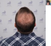 25-34 year old man treated with Hair Transplant, Hair Loss Treatment, Hair Loss, Hair Restoration, Smile Hair Clinic, FUE, FUE H