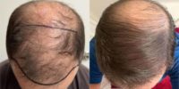 45-54 year old man treated with Hair Transplant, NeoGraft, FUE Hair Transplant