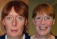 45-54 year old woman treated with Facial Feminization Surgery